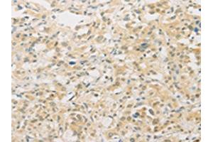 The image on the left is immunohistochemistry of paraffin-embedded Human thyroid cancer tissue using ABIN7129533(FNTA Antibody) at dilution 1/30, on the right is treated with fusion protein. (FNTA antibody)
