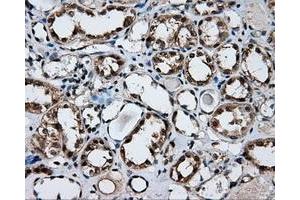 Immunohistochemical staining of paraffin-embedded Adenocarcinoma of ovary tissue using anti-FAHD2A mouse monoclonal antibody.