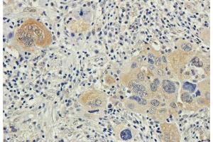 Immunohistochemical staining of human lung cancer using anti-Bax antibody. (Recombinant Bax (Active Monomer) (AA 12-24), (AA 3-16) antibody)