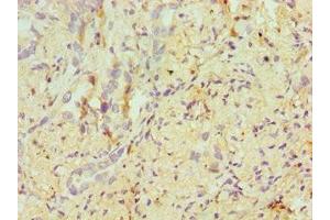 Immunohistochemistry of paraffin-embedded human lung cancer using ABIN7171955 at dilution of 1:100