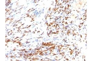 Formalin-fixed, paraffin-embedded human colon carcinoma stained with p27 antibody (DCS-72. (P27 antibody)