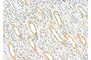 ABIN6262759 and ABIN6279680 at 1/100 staining Human kidney cancer and adjacent normal tissues by IHC-P.