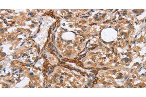 Immunohistochemistry of paraffin-embedded Human thyroid cancer tissue using BUB1 Polyclonal Antibody at dilution 1:50 (BUB1 antibody)