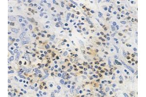 ABIN6259140 and ABIN6273984 at 1/100 staining human colon carcinoma by IHC-P.