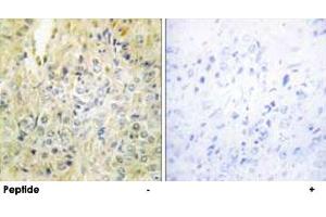 Immunohistochemistry analysis of paraffin-embedded human prostate carcinoma tissue, using DLEC1 polyclonal antibody . (DLEC1 antibody  (N-Term))