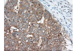 Immunohistochemical staining of paraffin-embedded Adenocarcinoma of Human breast tissue using anti-MIOX mouse monoclonal antibody. (MIOX antibody)