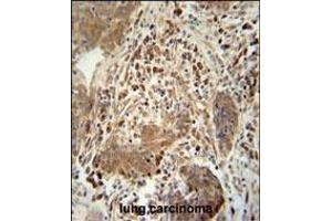 TAG antibody (Center) 10962c immunohistochemistry analysis in formalin fixed and paraffin embedded human lung carcinoma followed by peroxidase conjugation of the secondary antibody and DAB staining.