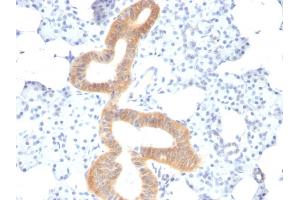 Formalin-fixed, paraffin-embedded human Melanoma stained with CD86 Mouse Monoclonal Antibody (SPM600). (CD86 antibody)