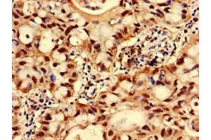 Immunohistochemistry of paraffin-embedded human lung cancer using ABIN7153896 at dilution of 1:100 (GNPNAT1 antibody  (AA 1-184))