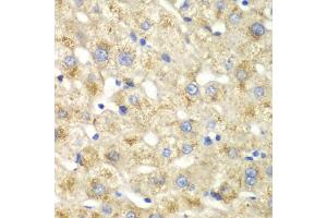 Immunohistochemistry of paraffin-embedded human liver injury using CALD1 antibody (ABIN5973102) at dilution of 1/100 (40x lens). (Caldesmon antibody)