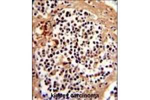 Formalin-fixed and paraffin-embedded human kidney carcinoma reacted with SERPINB7 Antibody (Center), which was peroxidase-conjugated to the secondary antibody, followed by DAB staining.