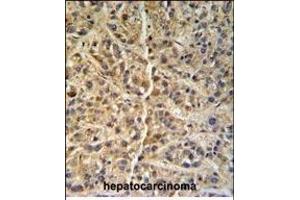 GNS Antibody (Center ) (ABIN390493 and ABIN2840852) IHC analysis in formalin fixed and paraffin embedded human hepatocarcinoma followed by peroxidase conjugation of the secondary antibody and DAB staining. (GNS antibody  (AA 283-313))