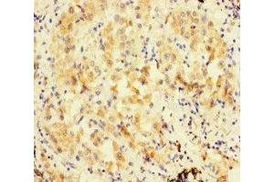 Immunohistochemistry of paraffin-embedded human lung cancer using ABIN7152480 at dilution of 1:100 (FBXL21 antibody  (AA 78-137))