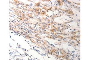 Immunohistochemical analysis of paraffin-embedded Human lung cancer tissue using at dilution 1/0.