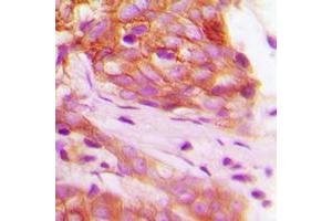 Immunohistochemical analysis of FGFR1 (pY766) staining in human breast cancer formalin fixed paraffin embedded tissue section.