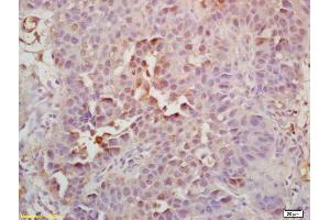 Formalin-fixed and paraffin embedded human bladder carcinoma labeled with Rabbit Anti Geminin Polyclonal Antibody, Unconjugated (ABIN1387623) at 1:200 followed by conjugation to the secondary antibody and DAB staining (Geminin antibody  (AA 110-142))