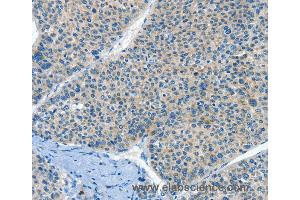 Immunohistochemistry of Human liver cancer using HID1 Polyclonal Antibody at dilution of 1:50 (HID1/DMC1 antibody)