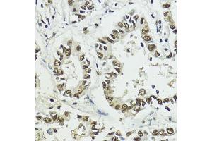 Immunohistochemistry of paraffin-embedded human lung cancer using Phospho-Histone H3-S10/T11 antibody (ABIN7267688) at dilution of 1:100 (40x lens). (Histone 3 antibody  (H3S10p, H3T11p))