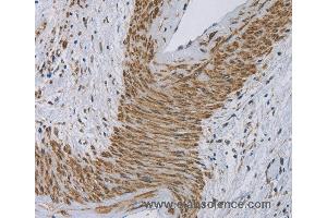 Immunohistochemistry of Human cervical cancer using CYB5A Polyclonal Antibody at dilution of 1:30 (Cytochrome b5 (CYTB5) antibody)