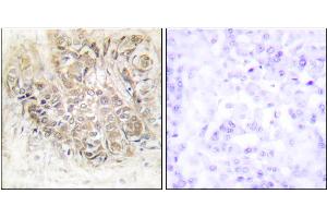 Immunohistochemistry analysis of paraffin-embedded human breast carcinoma tissue using TCTP antibody.