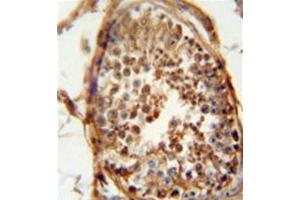 Formalin fixed and paraffin embedded human testis carcinoma reacted with DNAJB13 Antibody (Center) followed by peroxidase conjugation of the secondary antibody and DAB staining.