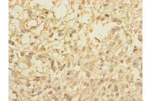 Immunohistochemistry of paraffin-embedded human melanoma using ABIN7148072 at dilution of 1:100