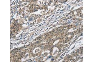 Immunohistochemical analysis of paraffin-embedded Human gastric cancer tissue using at dilution 1/30. (CACNA2D1 antibody  (Internal Region))