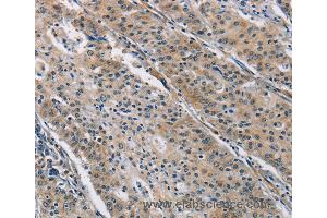 Immunohistochemistry of Human gastric cancer using BMP15 Polyclonal Antibody at dilution of 1:40