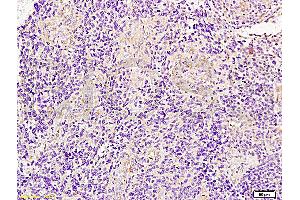Formalin-fixed and paraffin embedded human glioma tissue labeled with Anti-JUP/Cateninma ? (JUP antibody  (AA 601-700))