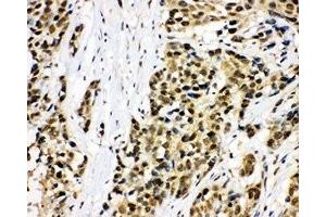 IHC-P: MCM7 antibody testing of human lung cancer tissue