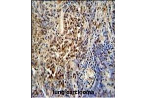 PUS3 antibody (N-term) (ABIN654789 and ABIN2844467) immunohistochemistry analysis in formalin fixed and paraffin embedded human lung carcinoma followed by peroxidase conjugation of the secondary antibody and DAB staining.