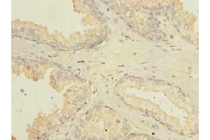 Immunohistochemistry of paraffin-embedded human prostate cancer using ABIN7165578 at dilution of 1:100 (Family with Sequence Similarity 92, Member A (FAM92A) (AA 1-271) antibody)