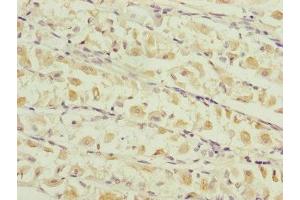 Immunohistochemistry of paraffin-embedded human gastric cancer using ABIN7159903 at dilution of 1:100 (TIMM17B antibody  (AA 1-172))