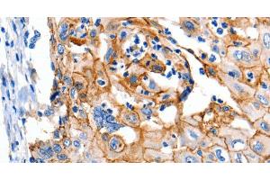 Immunohistochemistry of paraffin-embedded Human cervical cancer using Claudin 1 Polyclonal Antibody at dilution of 1:150 (Claudin 1 antibody)