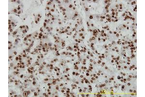 Immunoperoxidase of monoclonal antibody to HMGB1 on formalin-fixed paraffin-embedded human hepatocellular carcinoma tissue. (HMGB1 antibody  (AA 1-215))