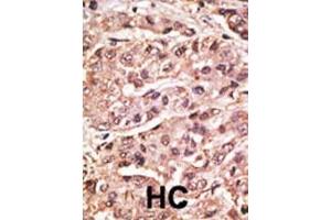 Formalin-fixed and paraffin-embedded human cancer tissue reacted with the primary antibody, which was peroxidase-conjugated to the secondary antibody, followed by DAB staining. (SUMO4 antibody  (Mutant, Val55))