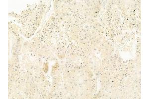 ABIN6261829 and ABIN6278464 at 1/100 staining human hepatocellular carcinoma by IHC-P. (CD15 antibody  (N-Term))