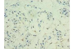 Immunohistochemistry of paraffin-embedded human breast cancer using ABIN7155309 at dilution of 1:100 (HDAC11 antibody  (AA 1-347))