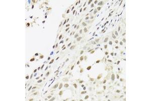 Immunohistochemistry of paraffin-embedded human lung cancer using C14orf166 antibody. (C14orf166 antibody)