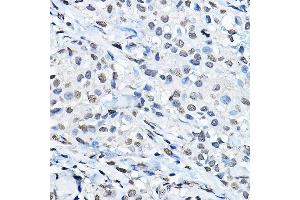 Immunohistochemistry of paraffin-embedded human breast cancer using MonoMethyl-Histone H3-K27 Rabbit pAb (ABIN3023262, ABIN3023263, ABIN3023264, ABIN1513004 and ABIN6219518) at dilution of 1:100 (40x lens). (Histone 3 antibody  (H3K27me1))