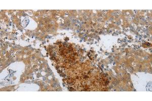 Immunohistochemistry of paraffin-embedded Human breast cancer using NGFR Polyclonal Antibody at dilution of 1:50 (NGFR antibody)