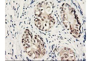 Immunohistochemical staining of paraffin-embedded Adenocarcinoma of Human breast tissue using anti-PSMB4 mouse monoclonal antibody.