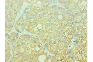 Immunohistochemical of paraffin-embedded human liver cancer using ABIN7143609 at dilution of 1:200 (Fetuin A antibody)
