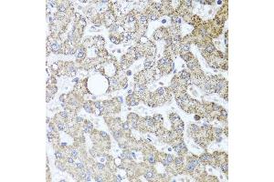 Immunohistochemistry of paraffin-embedded human liver injury using TSG101 antibody. (TSG101 antibody)
