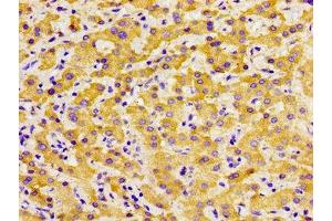 Immunohistochemistry of paraffin-embedded human liver cancer using ABIN7172602 at dilution of 1:100 (SOX11 antibody  (AA 241-341))