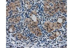 Immunohistochemical staining of paraffin-embedded Adenocarcinoma of colon tissue using anti-PTPRE mouse monoclonal antibody.