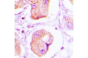 Immunohistochemical analysis of OLFM1 staining in human lung cancer formalin fixed paraffin embedded tissue section. (Olfactomedin 1 antibody)