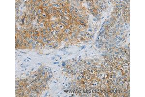 Immunohistochemistry of Human esophagus cancer using NDRG1 Polyclonal Antibody at dilution of 1:70