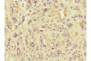 Immunohistochemistry of paraffin-embedded human melanoma using ABIN7159921 at dilution of 1:100 (IMMP2L antibody  (AA 1-100))