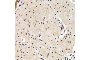 Immunohistochemistry of paraffin-embedded human gastric cancer using IRF2 antibody (ABIN3023366, ABIN3023367, ABIN3023368 and ABIN6219659) at dilution of 1:200 (40x lens).